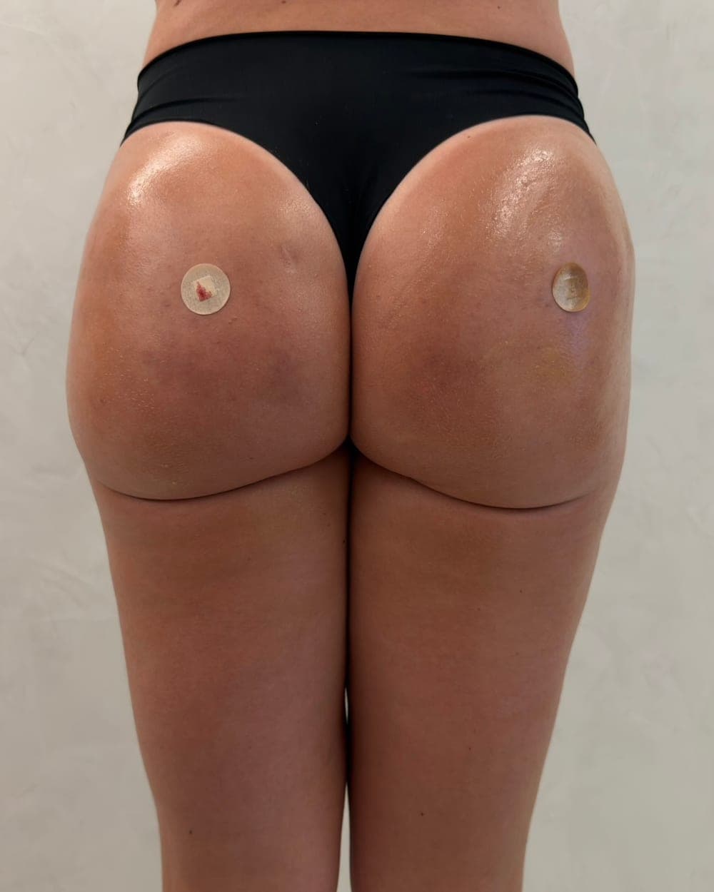 Paciente de costas após procedimento de estética de glúteos, com curativos nos pontos de aplicação