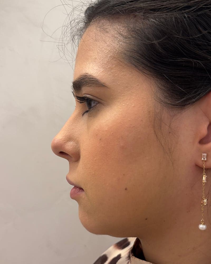 Antes: perfil de paciente em acompanhamento de harmonização facial