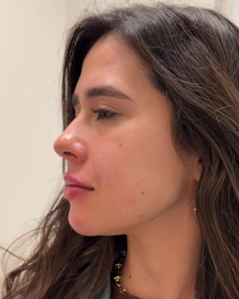 Depois: perfil de paciente em acompanhamento de harmonização facial