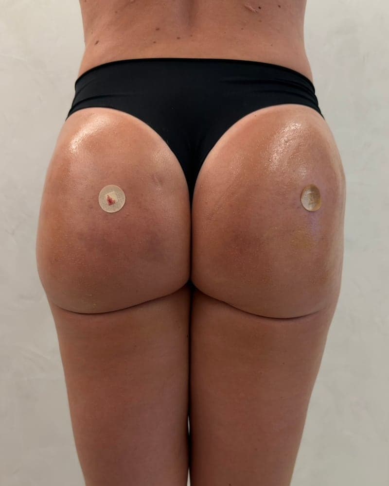 Depois: vista posterior de paciente em acompanhamento de estética de glúteos
